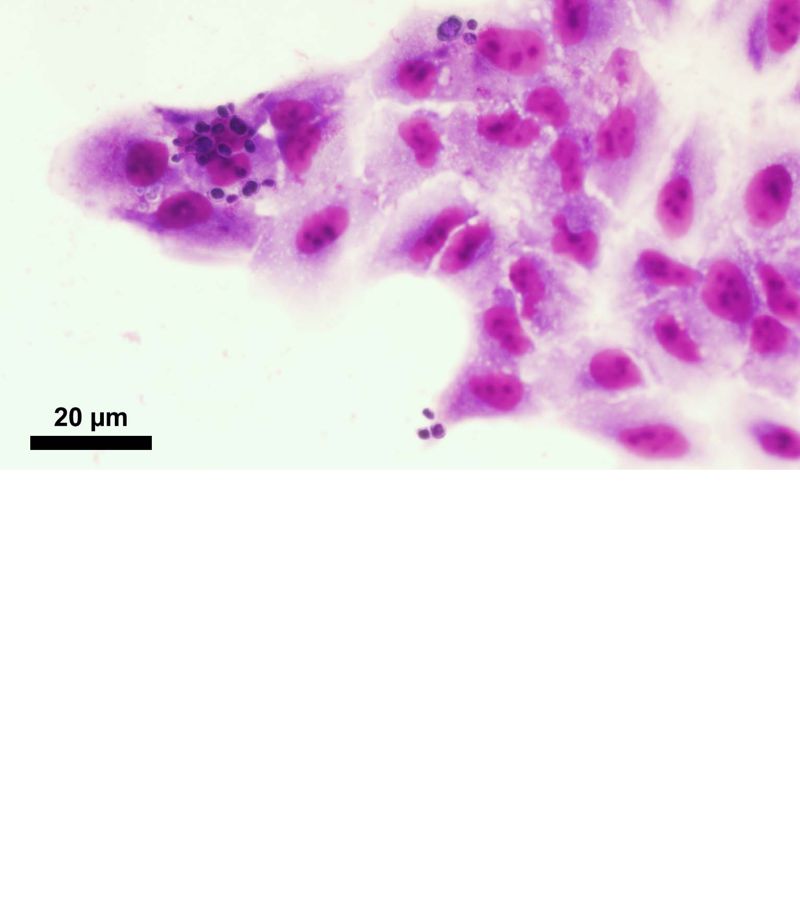 "Uma pedra no sapato". Leveduras de Paracoccidioides brasiliensis aderidas às células epiteliais pulmonares A549. Imagem tirada em aumento de 40x. Autor: Tarcisio Navegante de Queiroz Filho